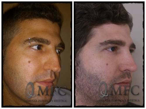 Rinoplastia